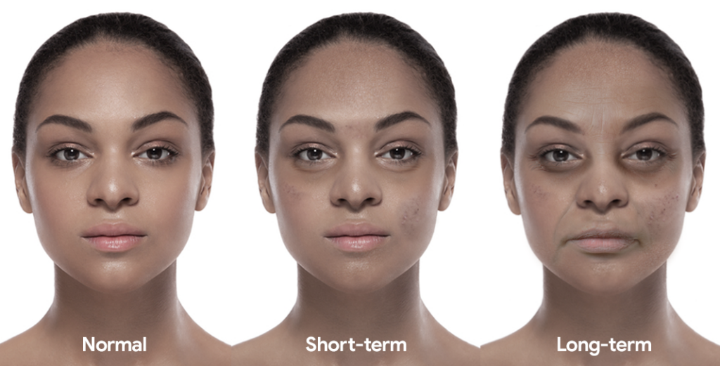 Woman showing before, short-term and long-term effects of sleep deprivation on the face